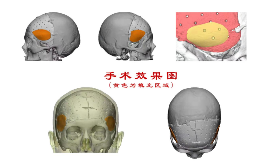 林志穎車禍致顏面骨折，醫(yī)生：或可用3D打印建模進行術(shù)后修復(fù)