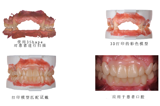 3Shape彩色工作流程，讓牙齒假體越來越“真”！